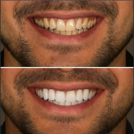 Teeth Whitening