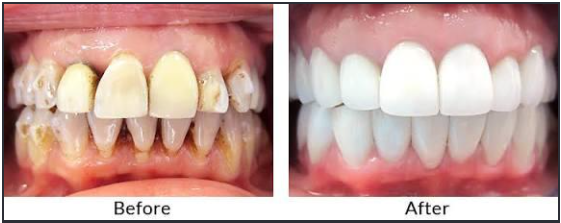 Teeth Cleaning & Polishing